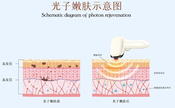 光子嫩膚術(shù)前注意事項(xiàng)有哪些？