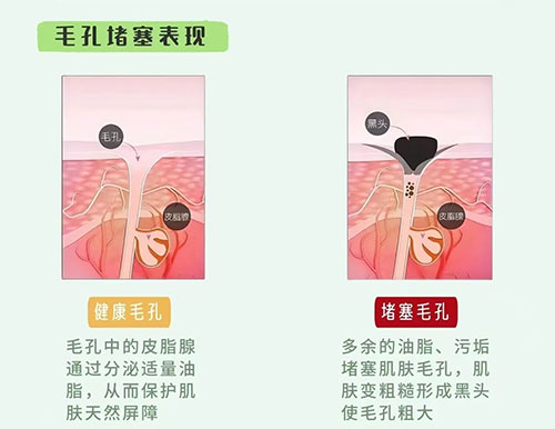 毛孔堵塞的表現(xiàn) 毛孔堵塞怎么疏通毛孔?