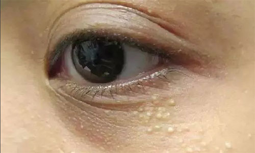 脂肪粒怎么樣才能去除？脂肪粒的去除方法！