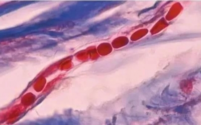 紅血絲是什么原因?qū)е碌?？紅血絲形成的原因！