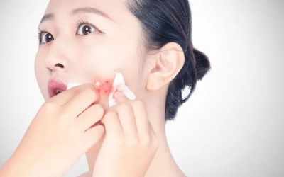 如何預(yù)防粉刺的發(fā)生和痤瘡的形成？