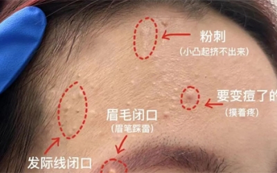 臉上經(jīng)常長(zhǎng)閉口粉刺的原因有哪些？