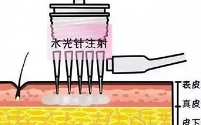 水光針的類型有哪幾種？