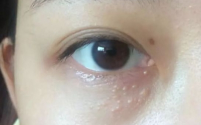 為什么眼部容易長脂肪粒？